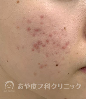ニキビ跡、ニキビ後の赤みの治療例
