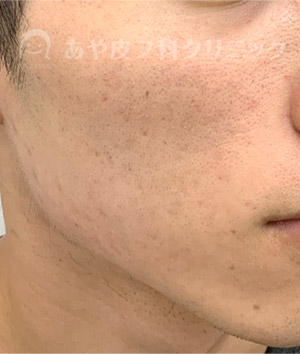 ニキビ後の赤みの治療・4回治療後